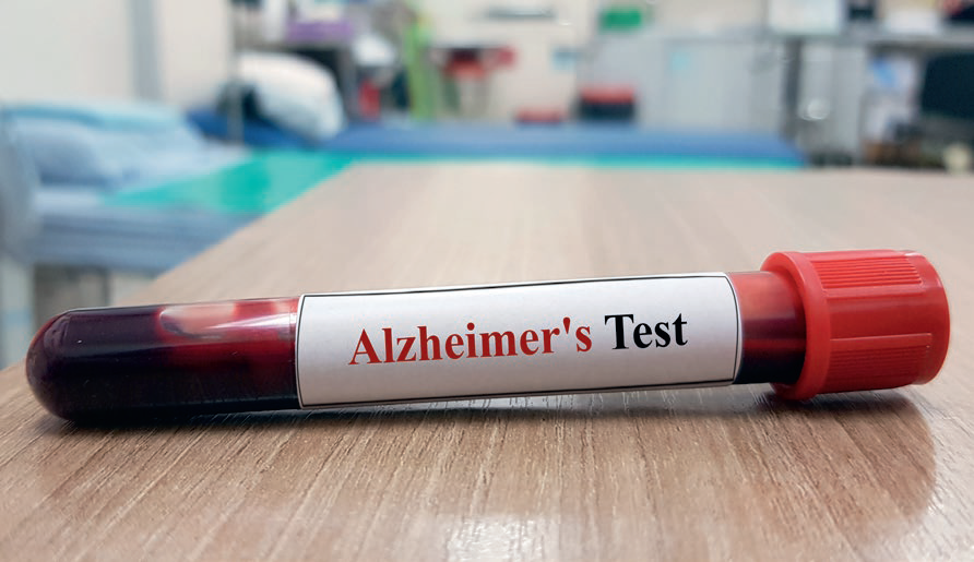 Blood-based biomarkers for alzheimer’s disease could greatly simplify diagnosis and reduce costs © joel bubble ben-Shutterstock.com