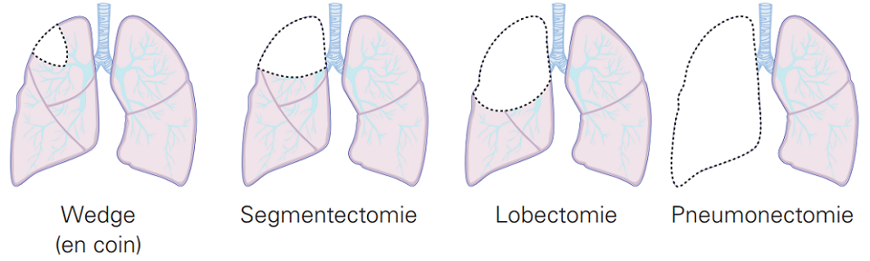 4 types de résection pulmonaire