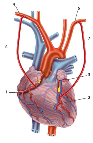 Les différents types de pontage coronaire - Service de chirurgie cardiaque  à Genève aux HUG - HUG