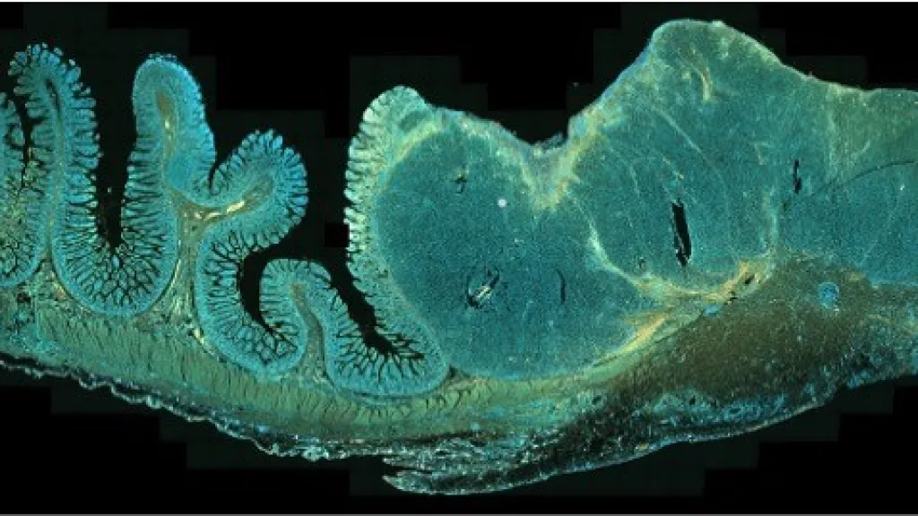 Analyse immunohistochimique d’une coupe de métastase intestinale de mélanome