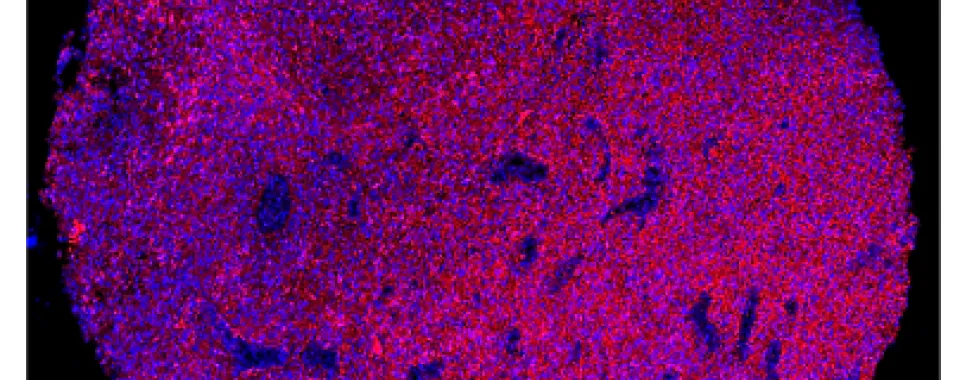 Immunofluorescence staining of a representative human glioblastoma tissue section. In red, the PTPRZ1 markers, and in blue, the cell nuclei. (scale bar: 400 μm) © Denis Migliorini - UNIGE/HUG